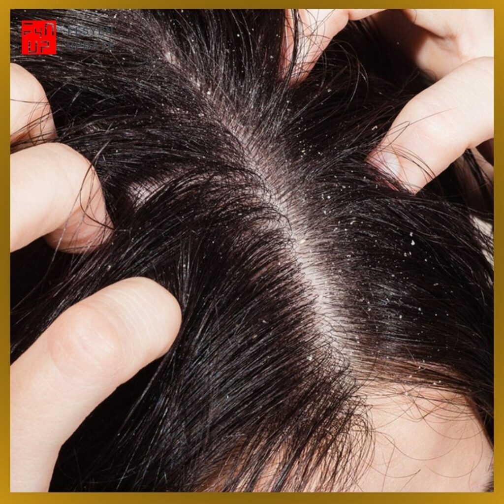 Imej Manfaat Minyak Zaitun untuk Rambut Mengurangkan gatal-gatal kulit kepala